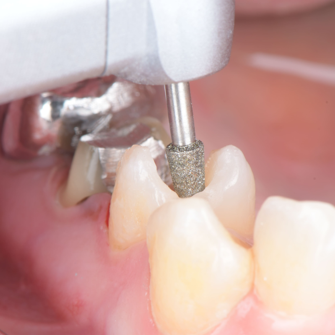 Dentaire Achat : Les Fraises Dentaire au meilleur prix!